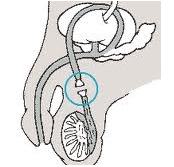 Vasectomia