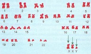 Anomalia genética de Klinefelter