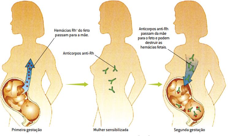 Desenvolvimento da eritroblastose fetal. 