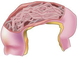 Lombrigas no intestino.