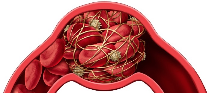 Representação de uma artéria com coágulo obstruindo a passagem do sangue.