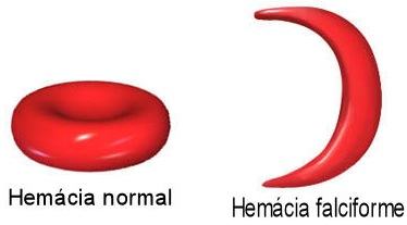 Formato das hemácias falciformes