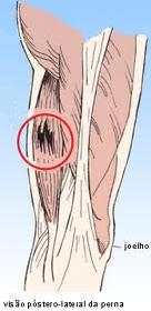 Distenção muscular da perna