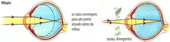 O problema da miopia